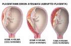ABLASYO PLASENTA : PLASENTANIN (BEBEĞİN EŞİ) ERKEN AYRILMASI