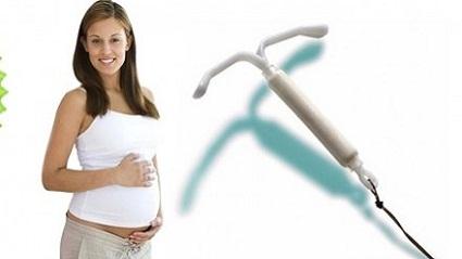 YÜKSEK ETKİLİ VE KULLANIMI KOLAY BİR DOĞUM KONTROLÜ YÖNTEMİ: HORMONLU SPİRAL