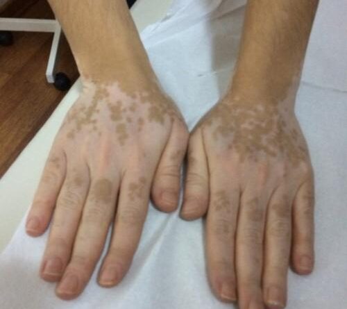 VİTİLİGO (ALA HASTALIĞI) HAKKINDA BİLMENİZ GEREKENLER