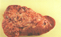 BÖBREK KANSERİ
